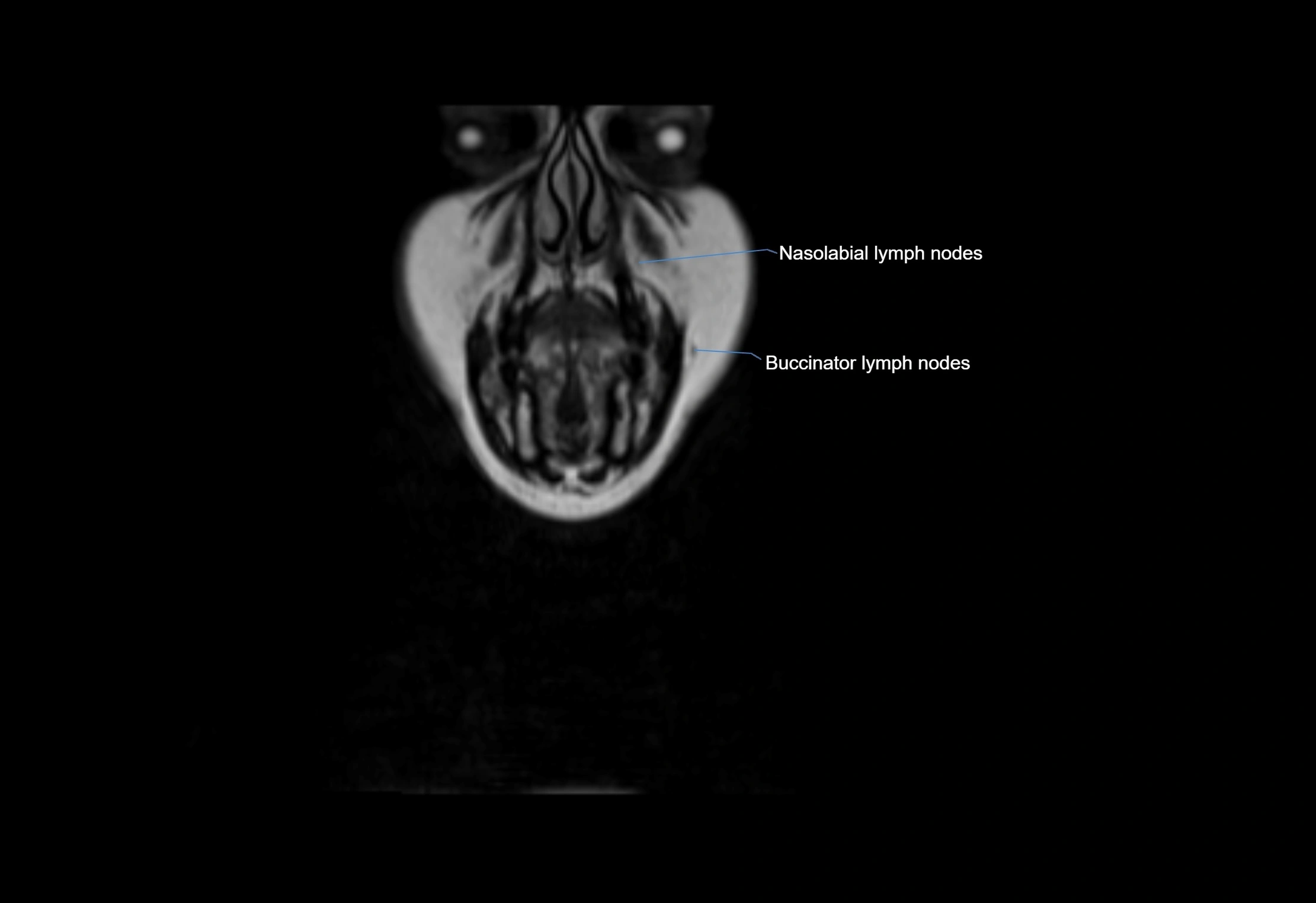 Neck coronal lymph node cross sectional MRI anatomy 3T MRI  image-img-00001-00071.webp